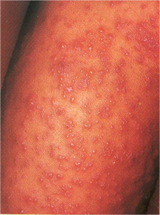 Contact dermatitis - Mayo Clinic