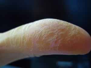 contact_dermatitis_finger