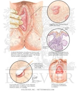 Molluscum Contagiosum