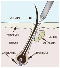 electrolysis hair removal