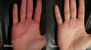 LED-Phototherapy-eczema-hands-before-and-after