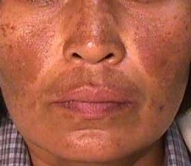 Causes of Melasma | MelasmaCreams 2014