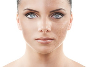 glycolic acid peel treatments