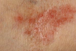 Retinol skin rash